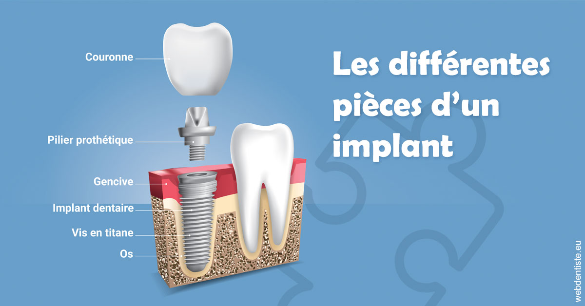 https://www.dr-paradisi.com/Les différentes pièces d’un implant 1